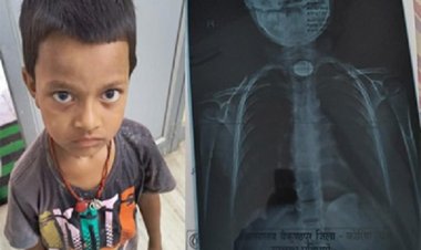 मासूम के गले में फंसे सिक्के को डॉक्टरों ने सफलतापूर्वक निकाला