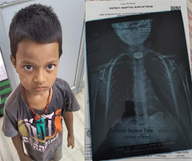 मासूम के गले में फंसे सिक्के को डॉक्टरों ने सफलतापूर्वक निकाला