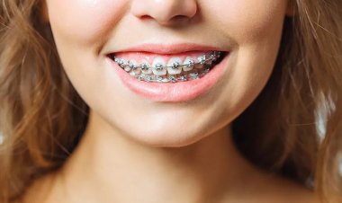 ओरल हाइजीन डे विशेष: ब्रेसेस से पाएं स्वस्थ दांत, बेहतर मुस्कान