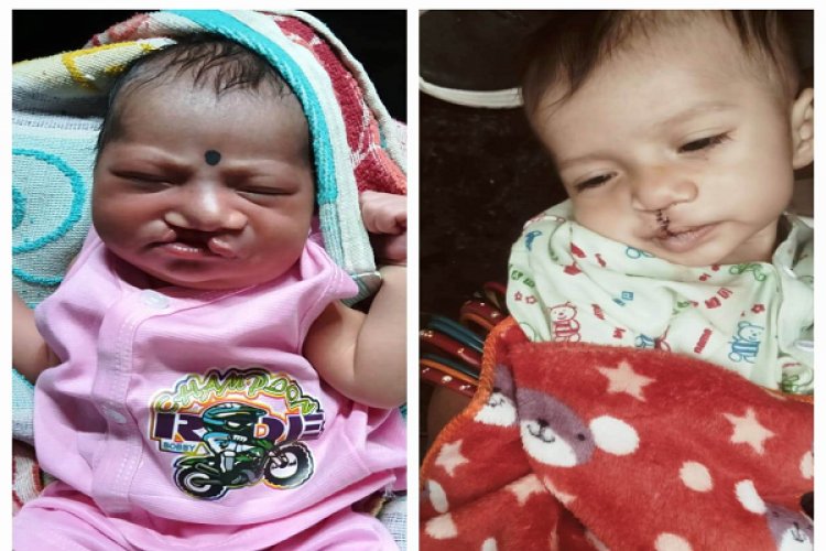 रायपुर : चिरायु योजना से नन्हें शिवम को मिली नई मुस्कान